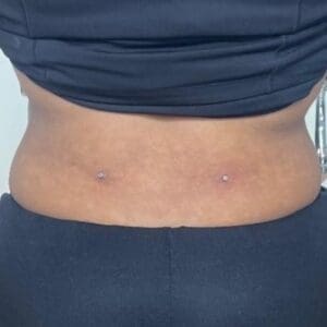 Back Dermals