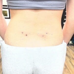 Back Surface Bars